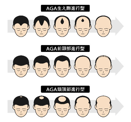 男性の薄毛（AGA）