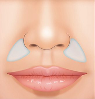 鼻翼基部プロテーゼ移植（貴族手術）