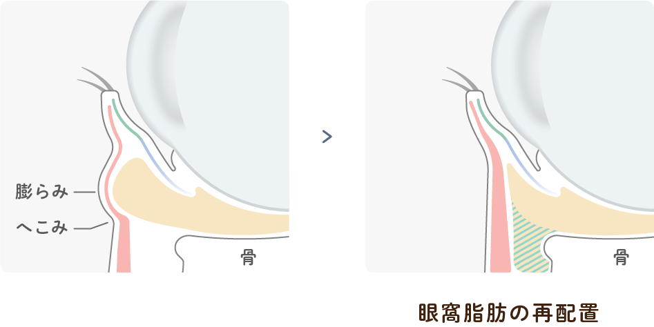 下眼瞼形成術（ハムラ法）