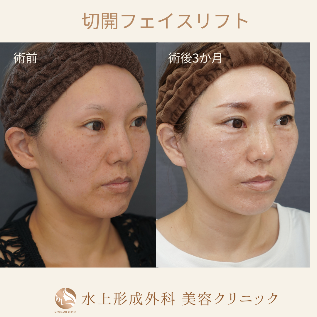 切開フェイスリフト①