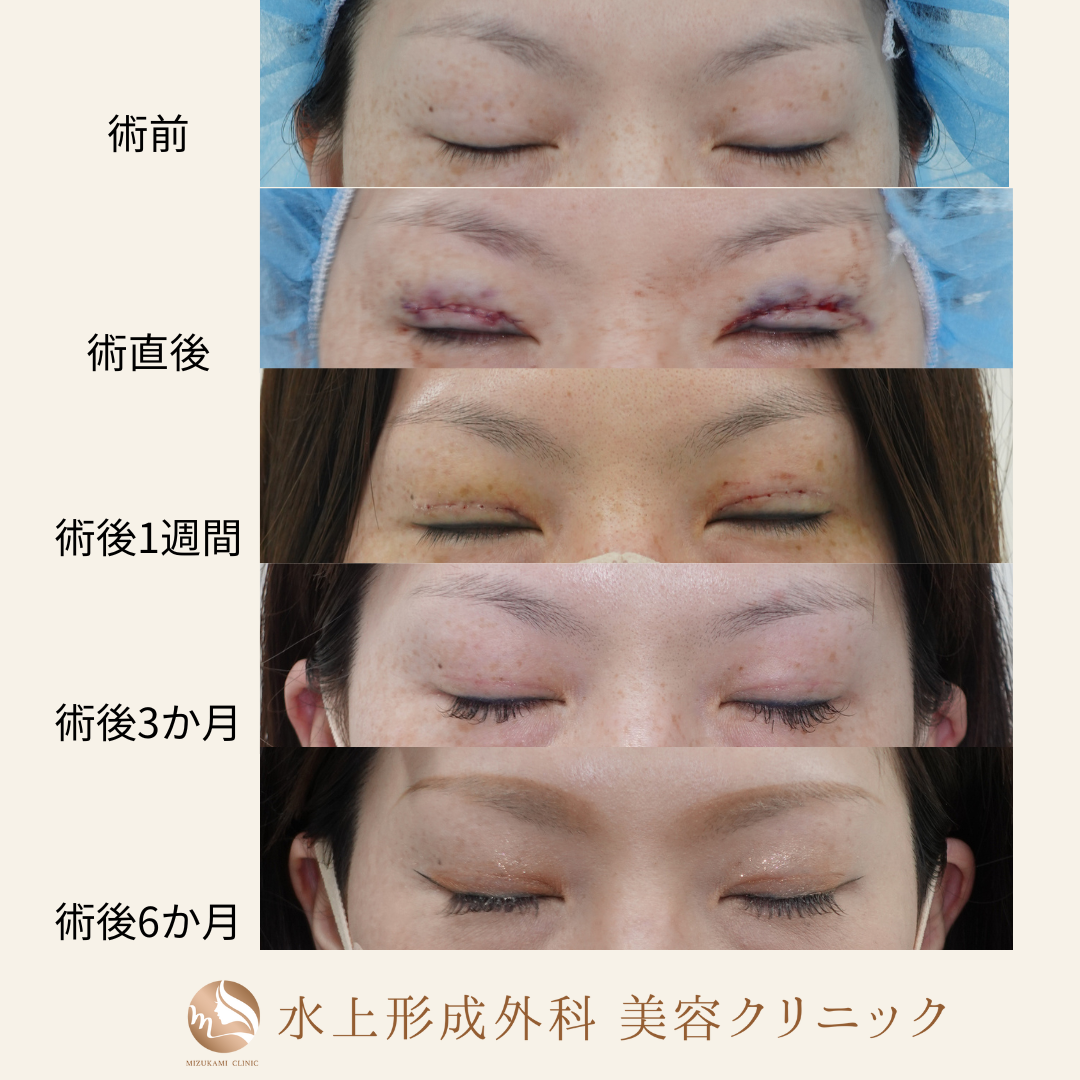 眼瞼下垂症手術②の症例写真5