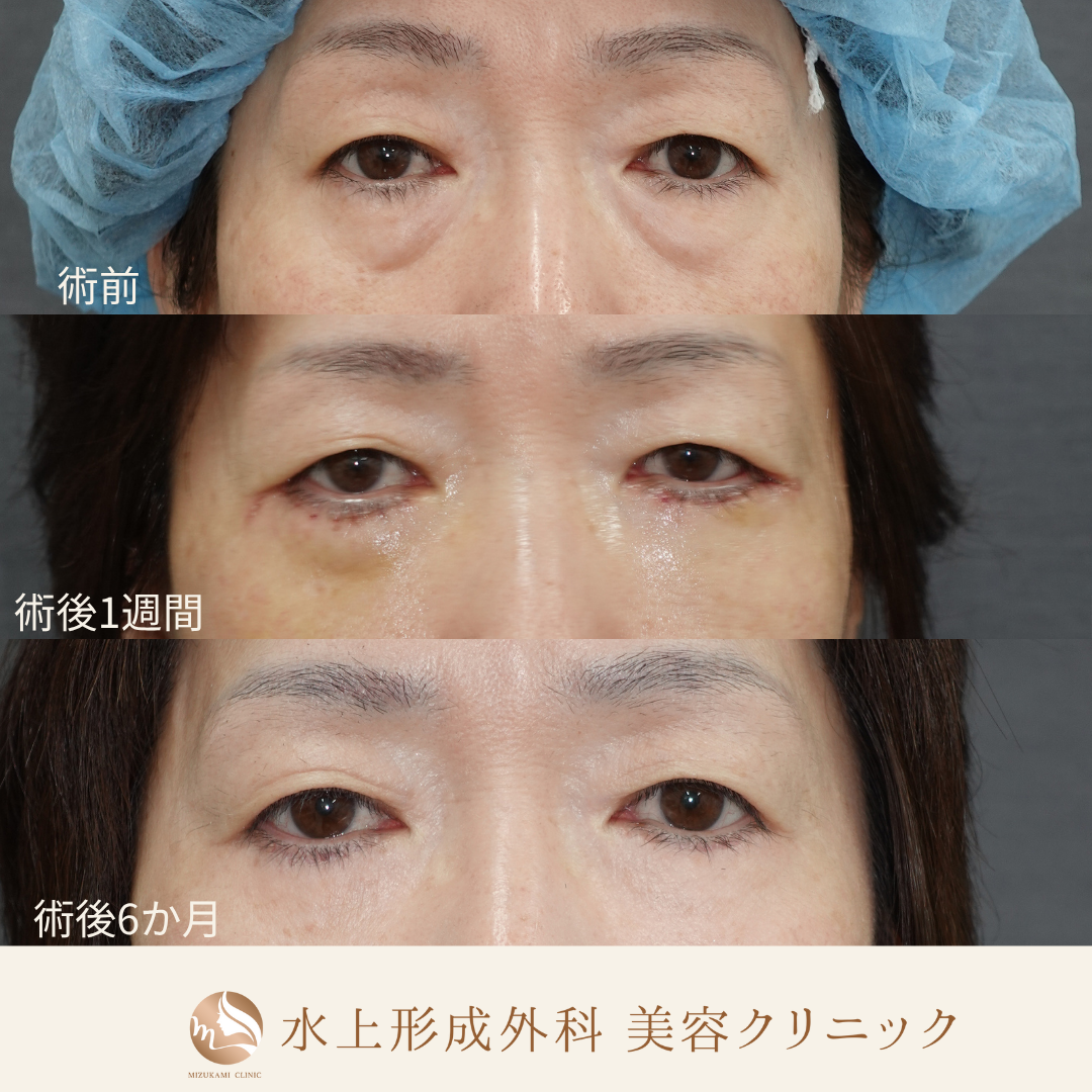 クマ取り（表ハムラ法）③の症例写真3