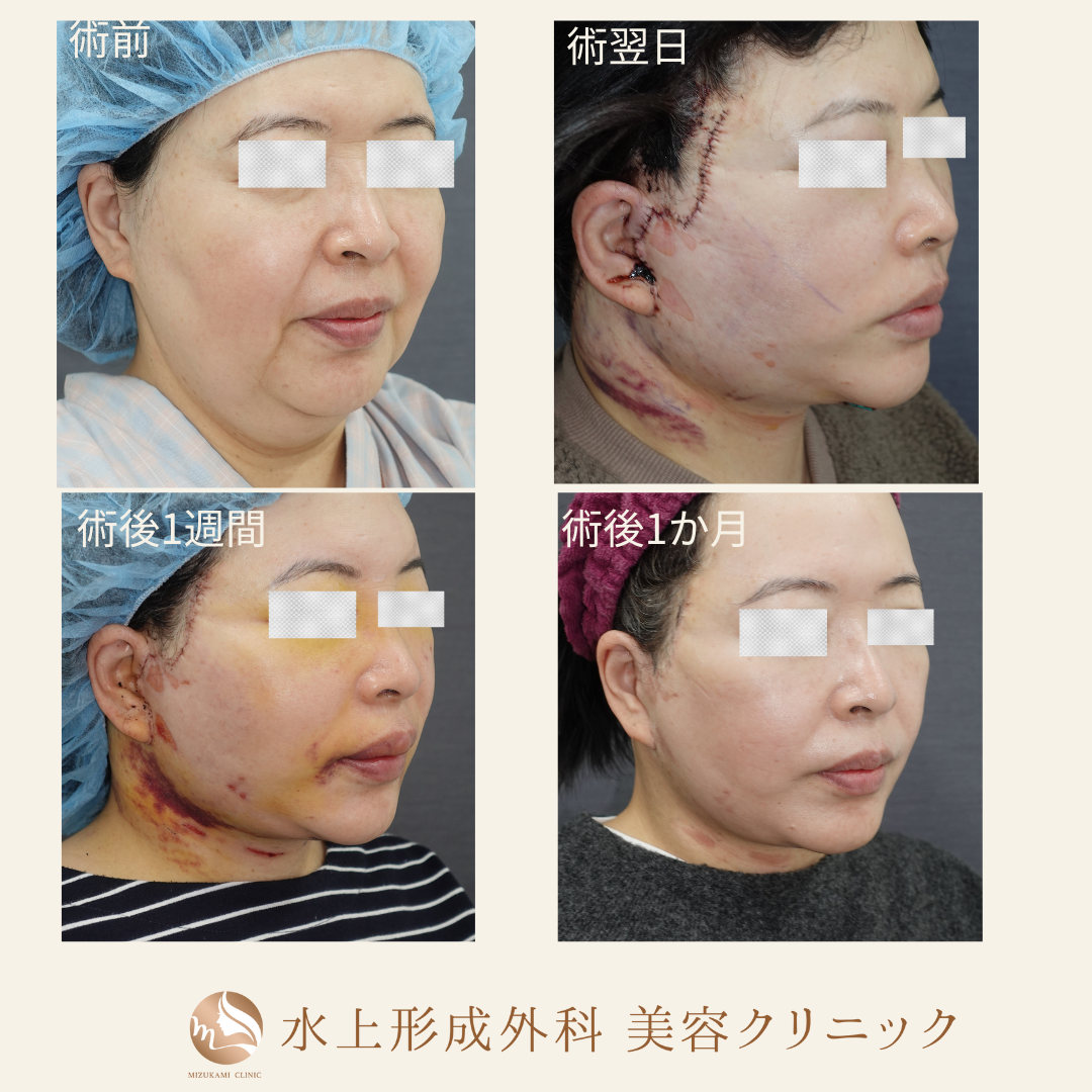 切開フェイスリフト・ペリカン手術①の症例写真5