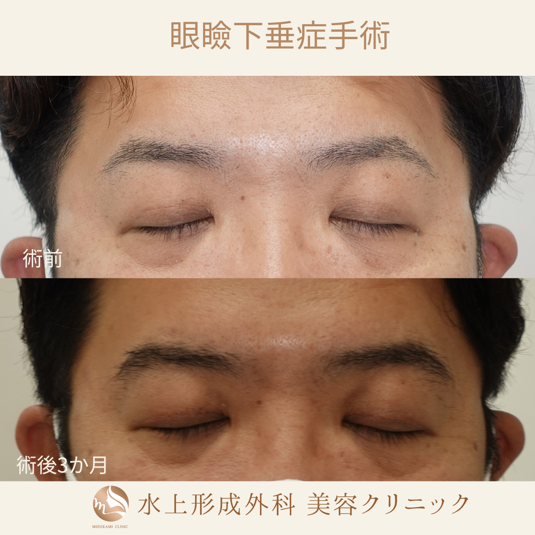 眼瞼下垂症手術①の症例写真2