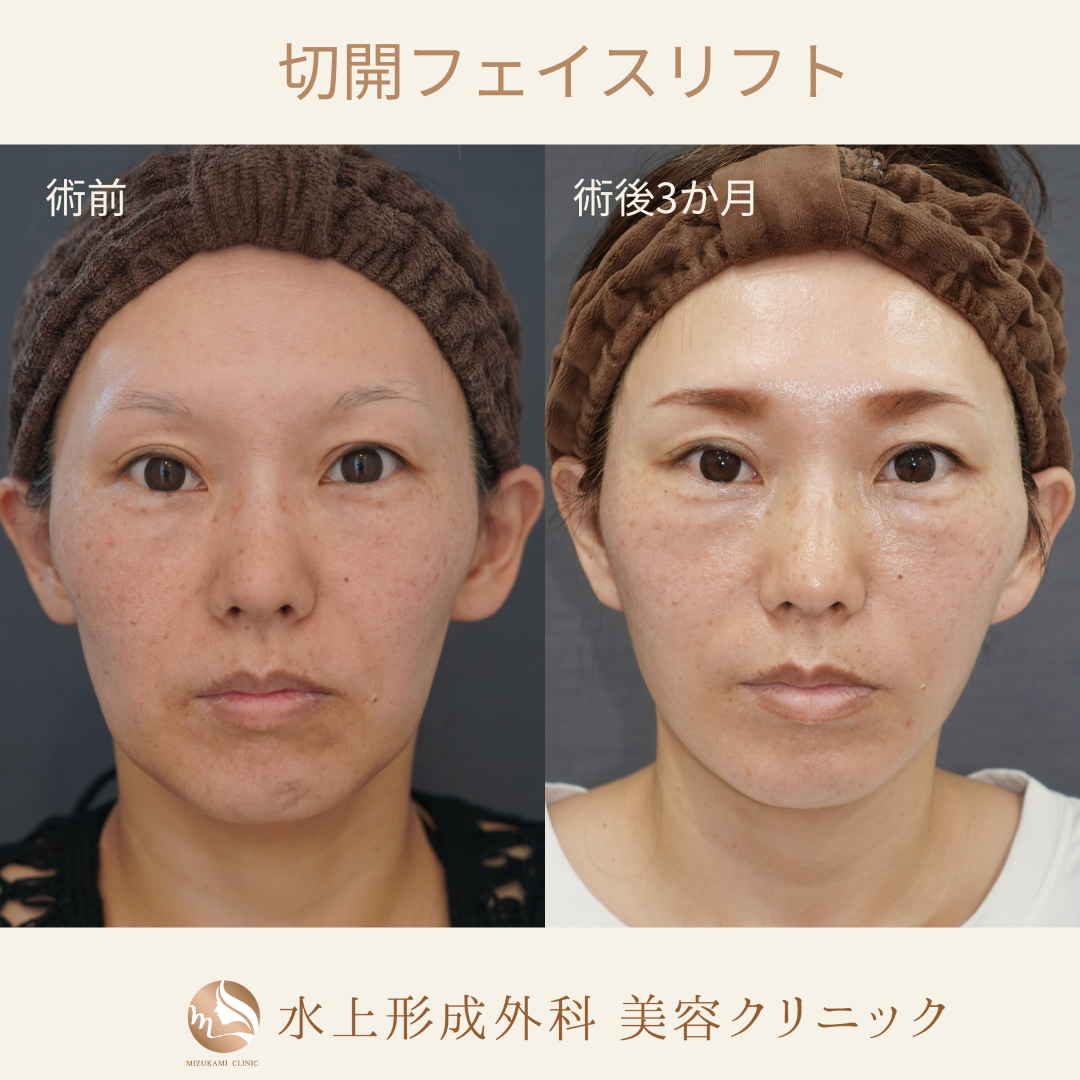 切開フェイスリフト①の症例写真2