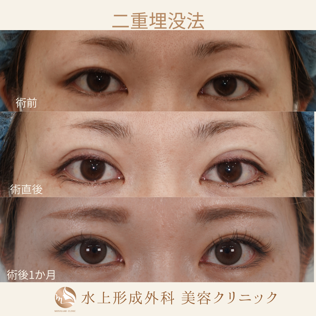 二重埋没法④の症例写真3