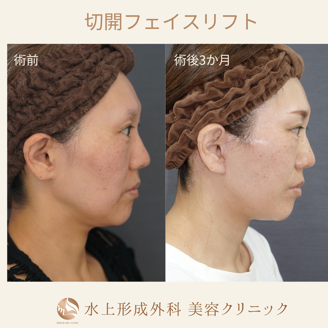 切開フェイスリフト①の症例写真3