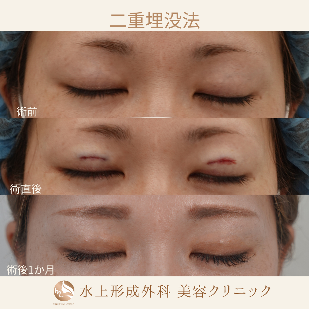 二重埋没法④の症例写真4