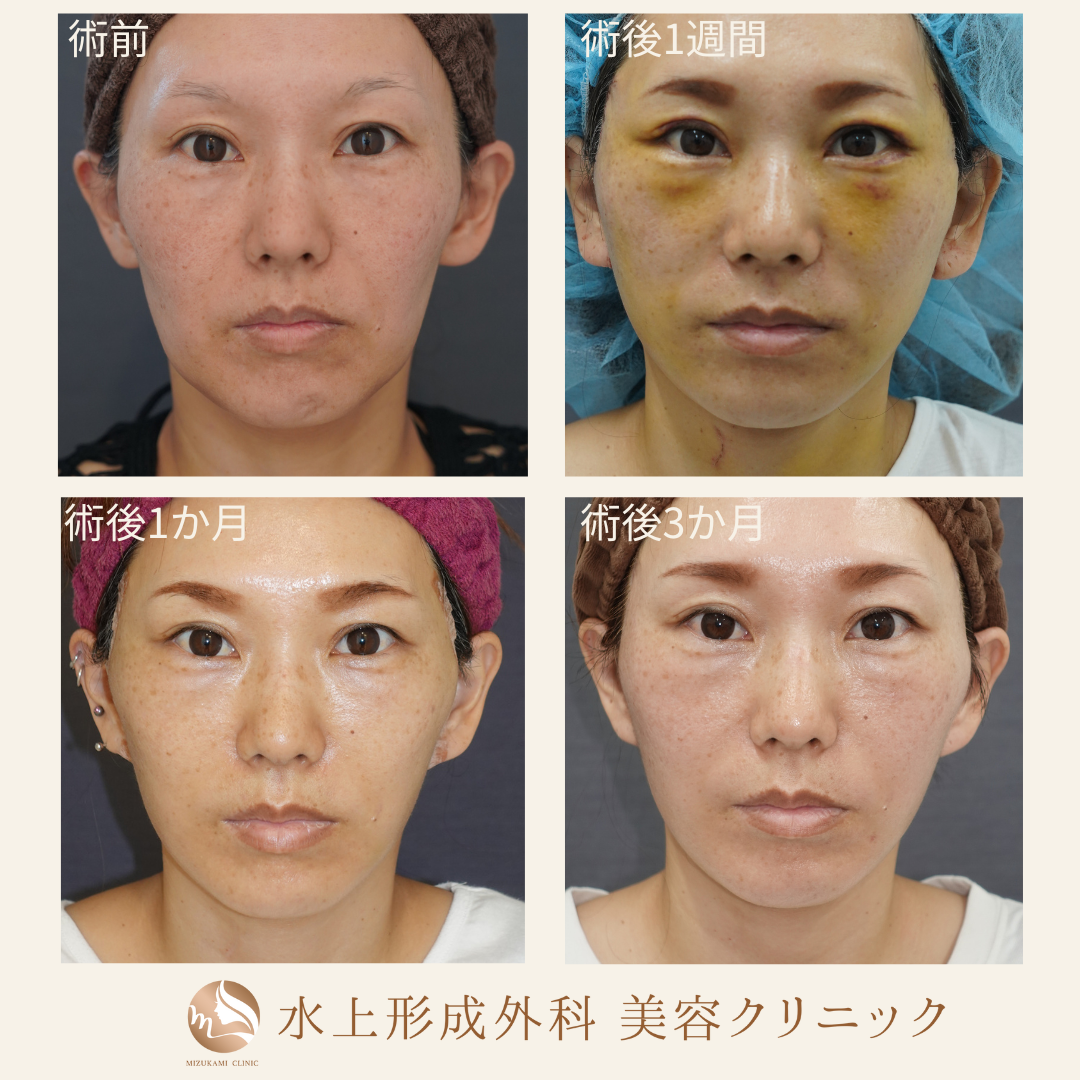 切開フェイスリフト①の症例写真4