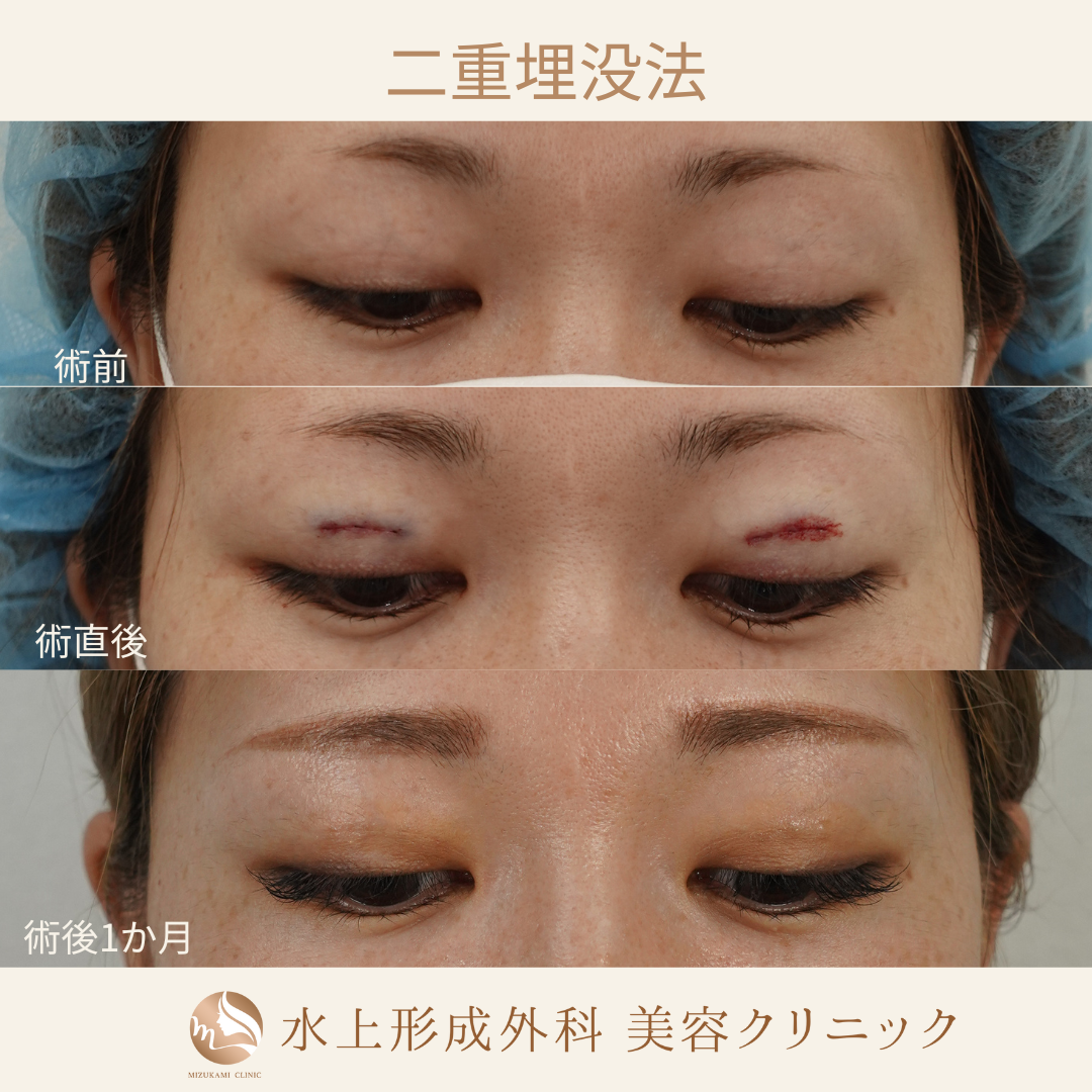 二重埋没法④の症例写真5