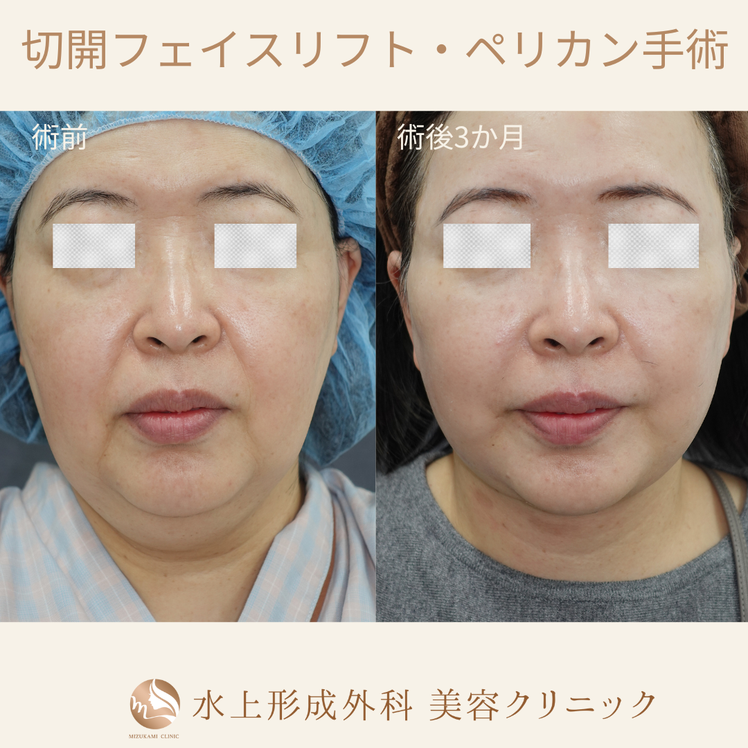 切開フェイスリフト・ペリカン手術①の症例写真2