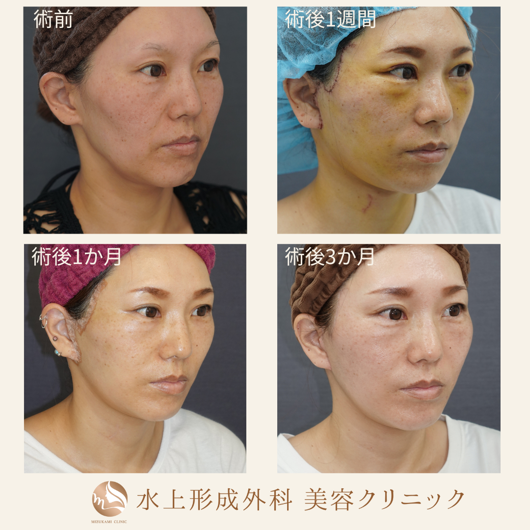 切開フェイスリフト①の症例写真5