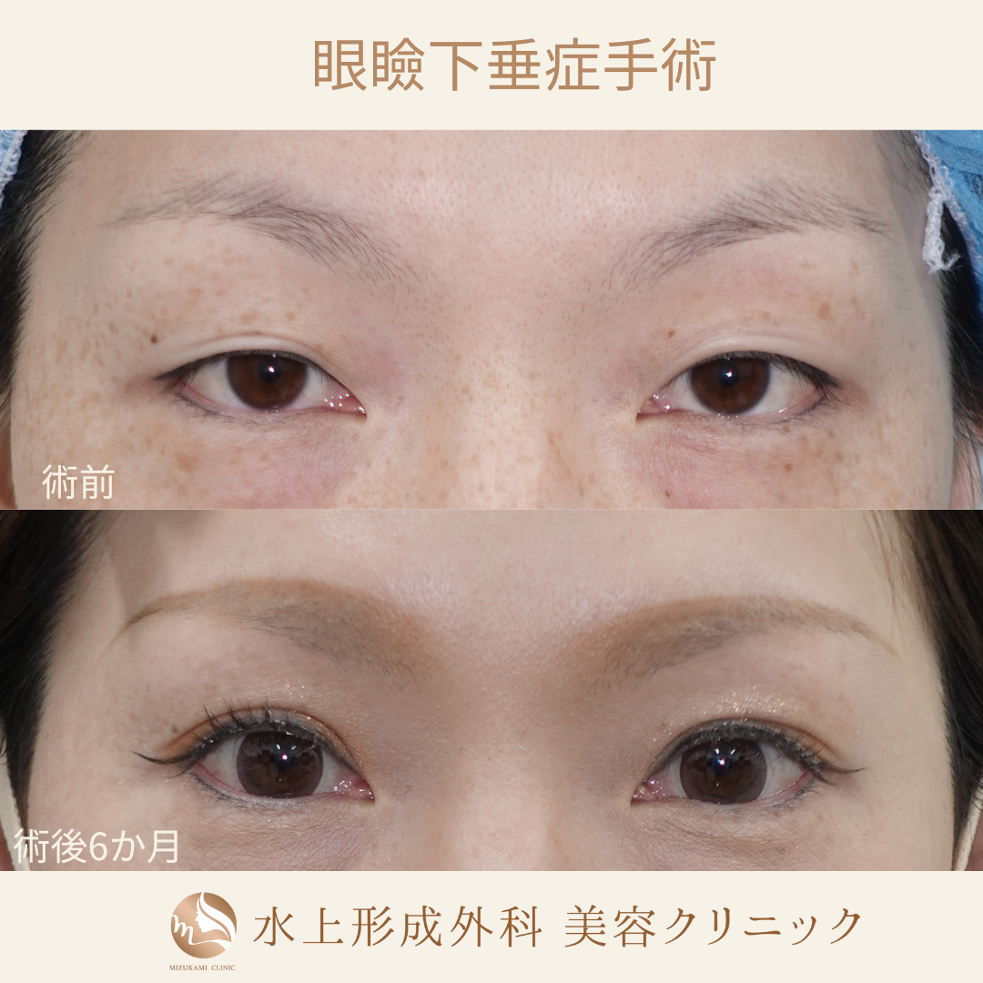 眼瞼下垂症手術②