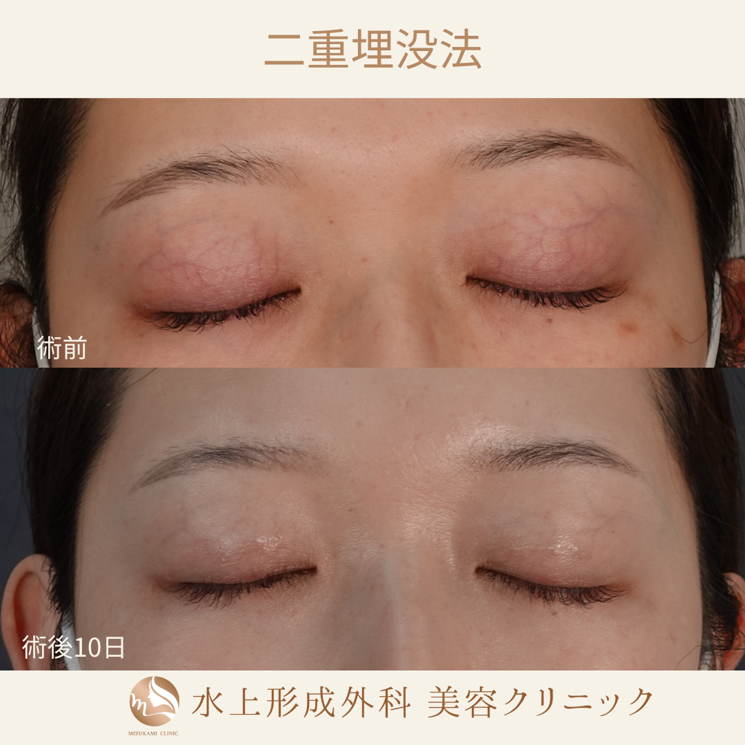 二重埋没法⑤の症例写真2