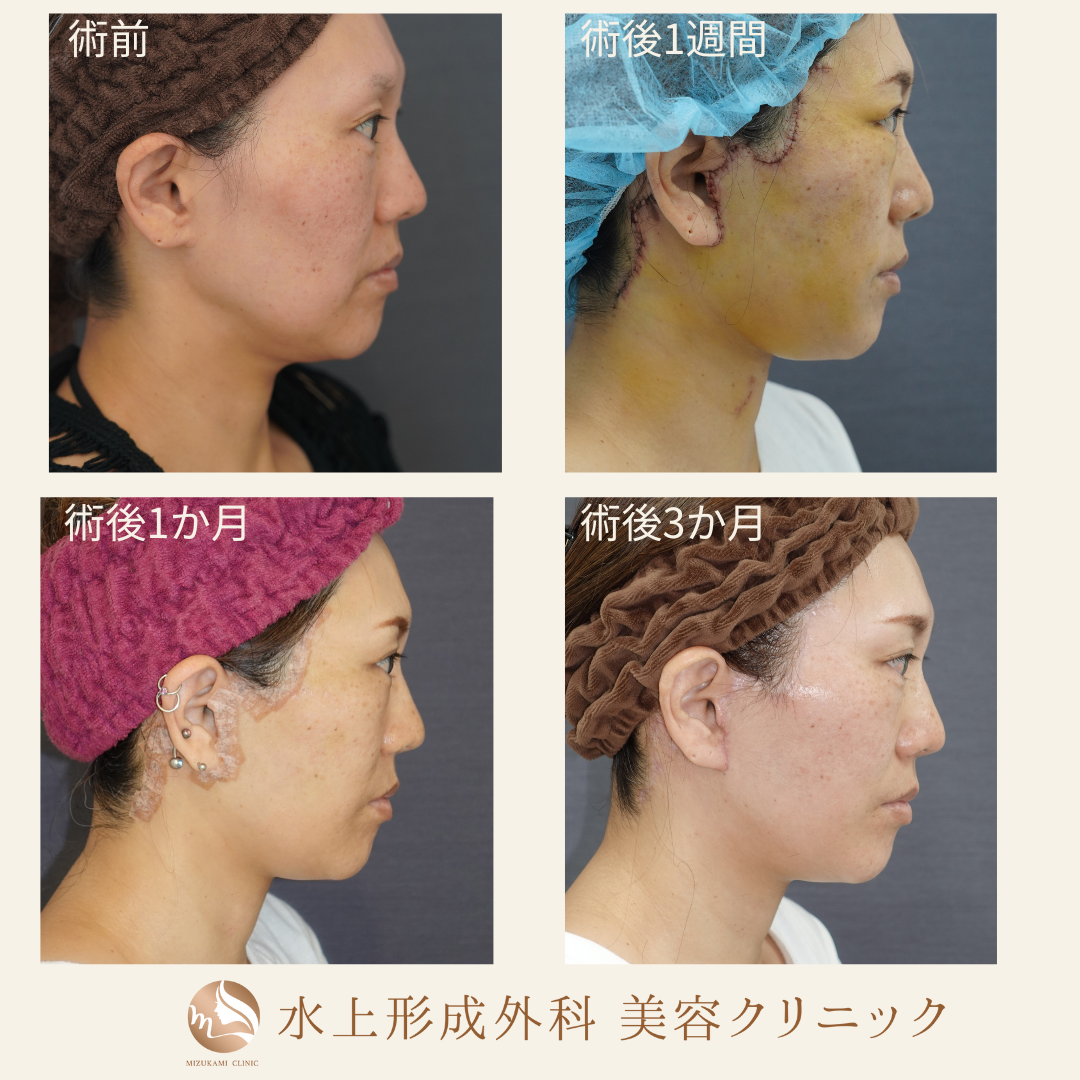 切開フェイスリフト①の症例写真6