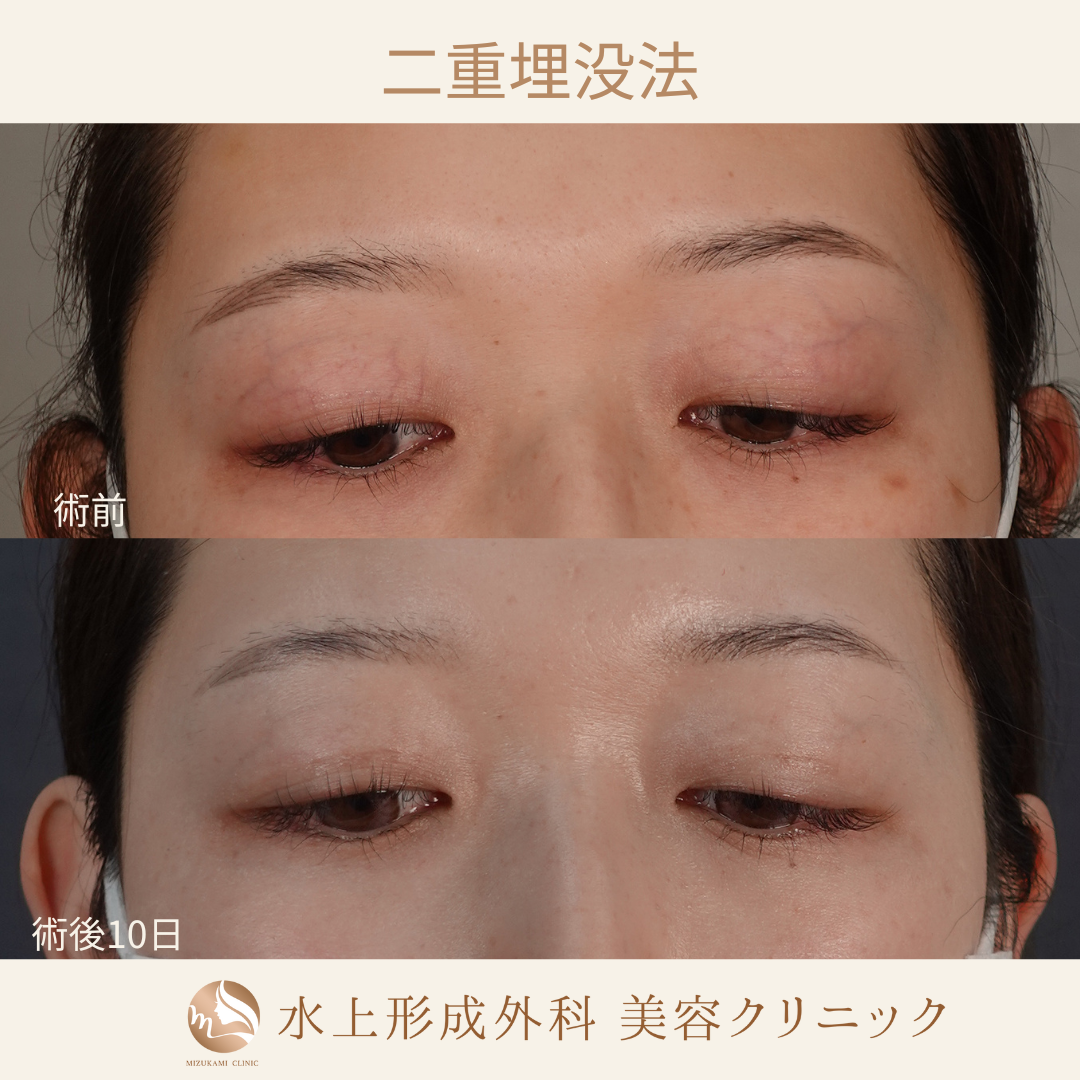 二重埋没法⑤の症例写真3