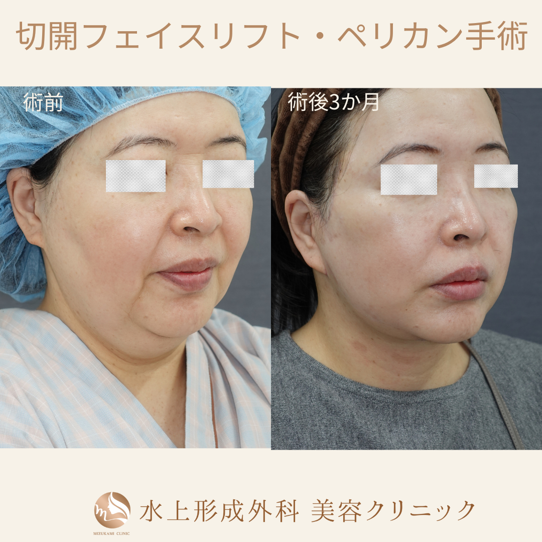 切開フェイスリフト・ペリカン手術①