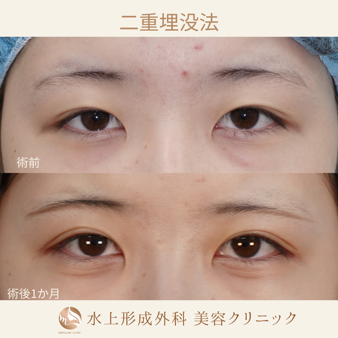 二重埋没法⑥