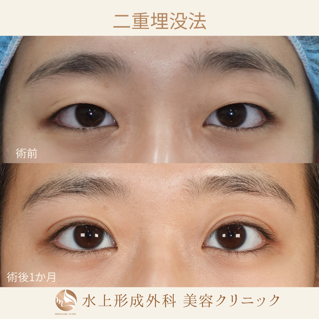 二重埋没法⑦
