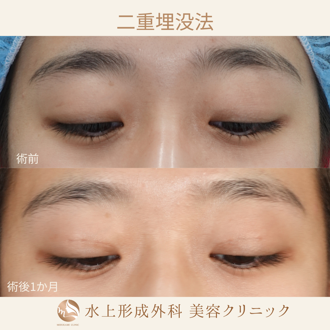 二重埋没法⑦の症例写真3