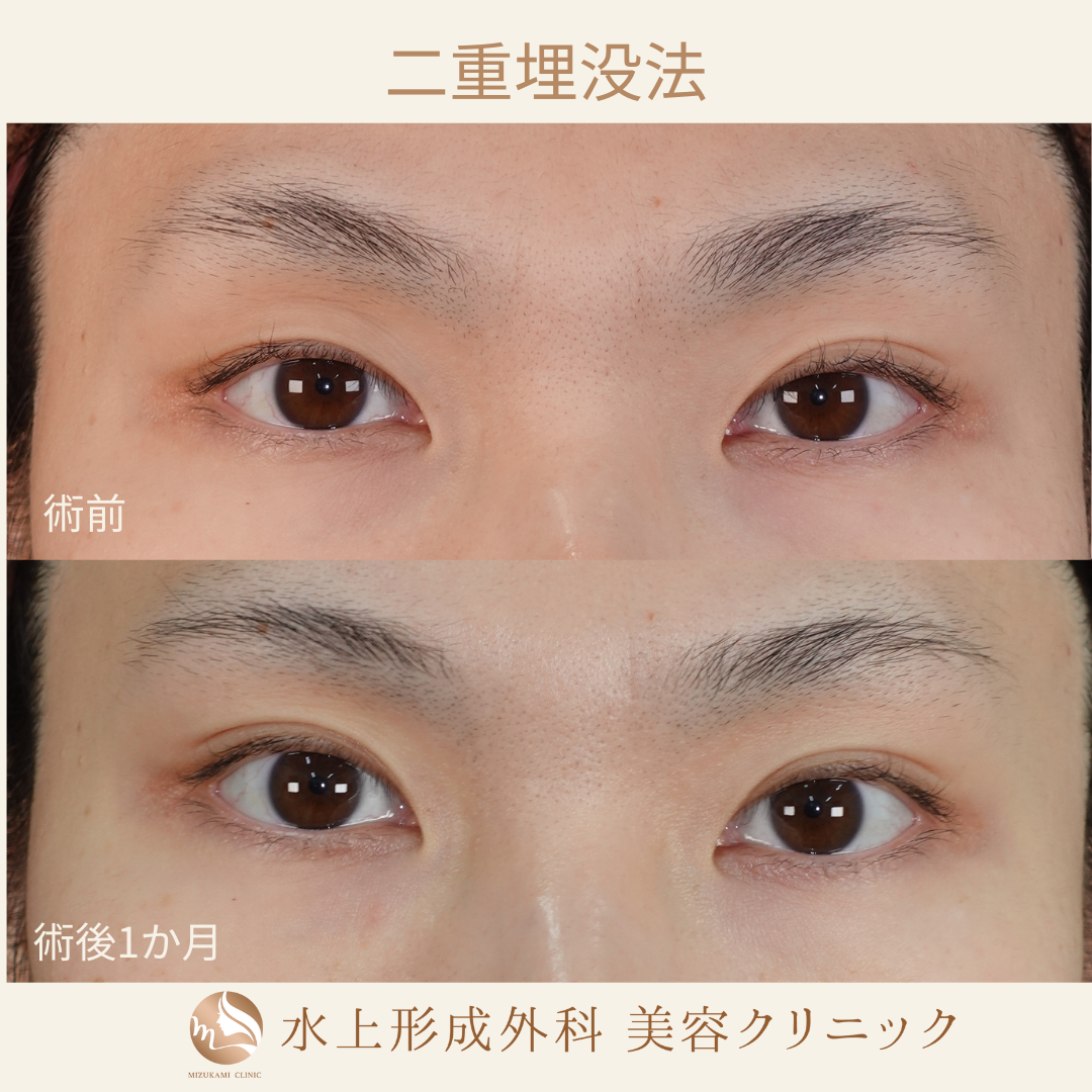 二重埋没法