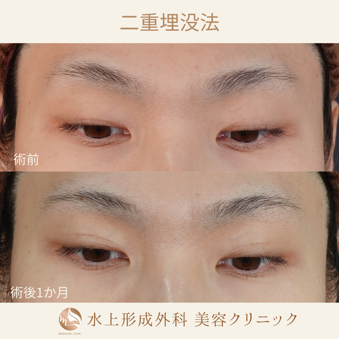 二重埋没法の症例写真3