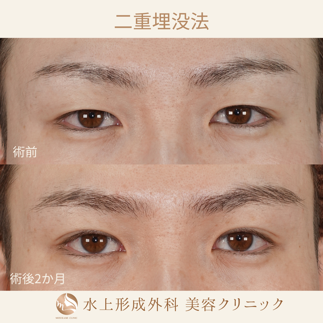 二重埋没法