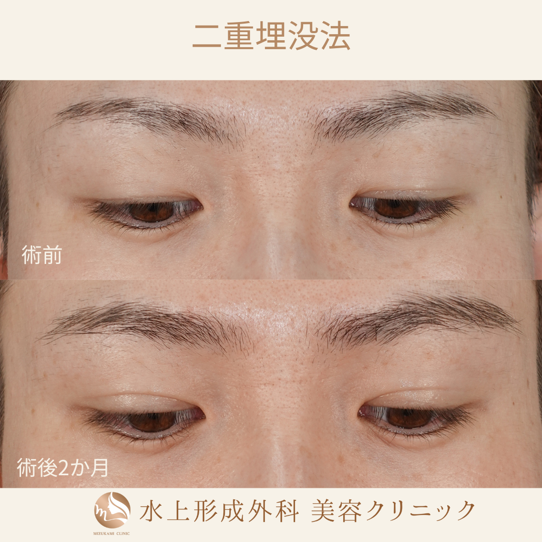 二重埋没法の症例写真3