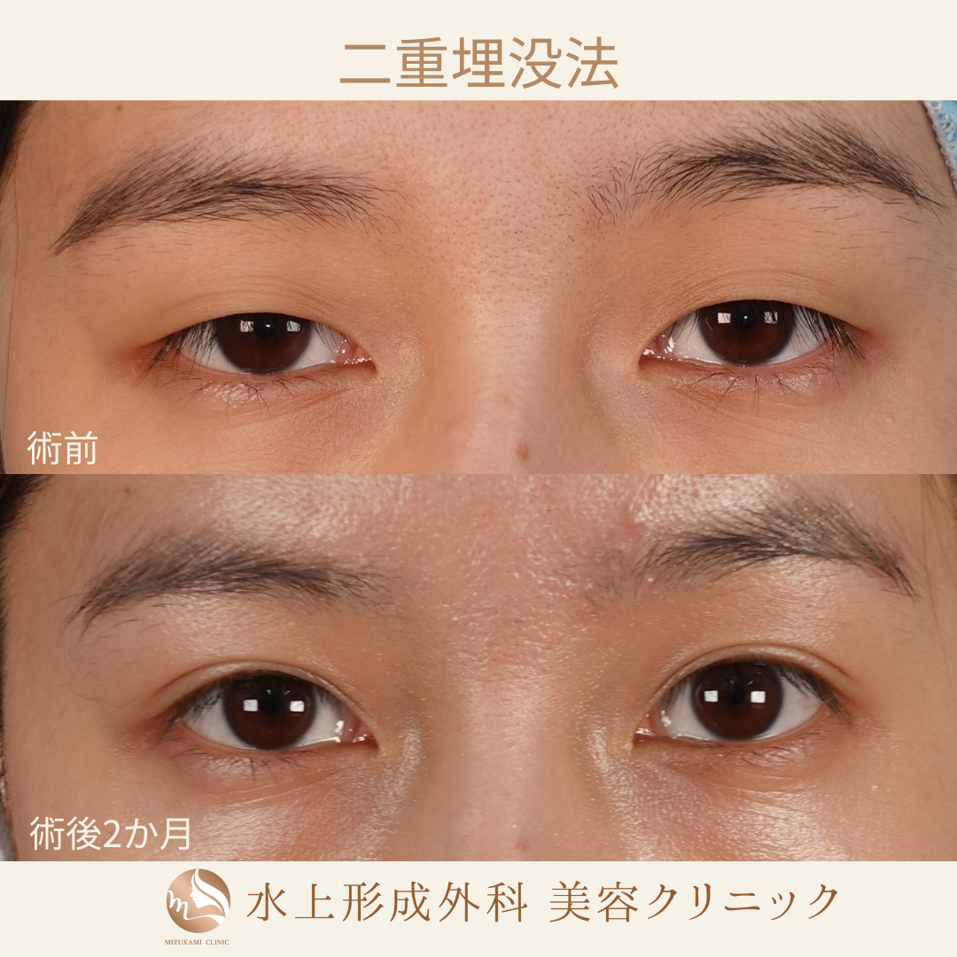 二重埋没法⑧