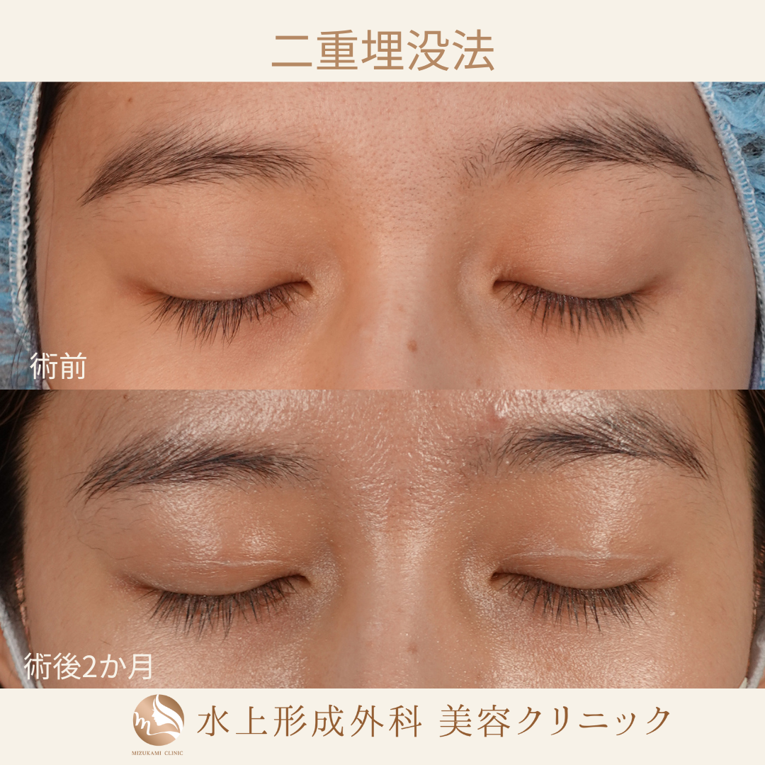 二重埋没法⑧の症例写真2