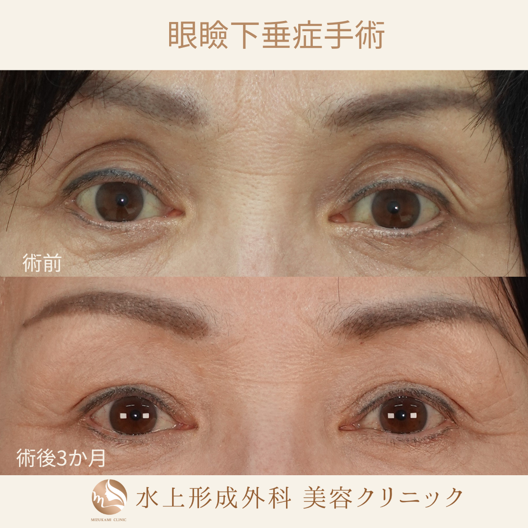 眼瞼下垂症手術