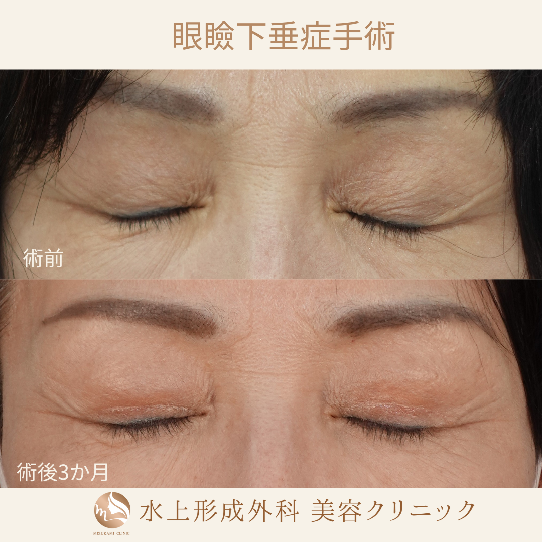 眼瞼下垂症手術の症例写真2