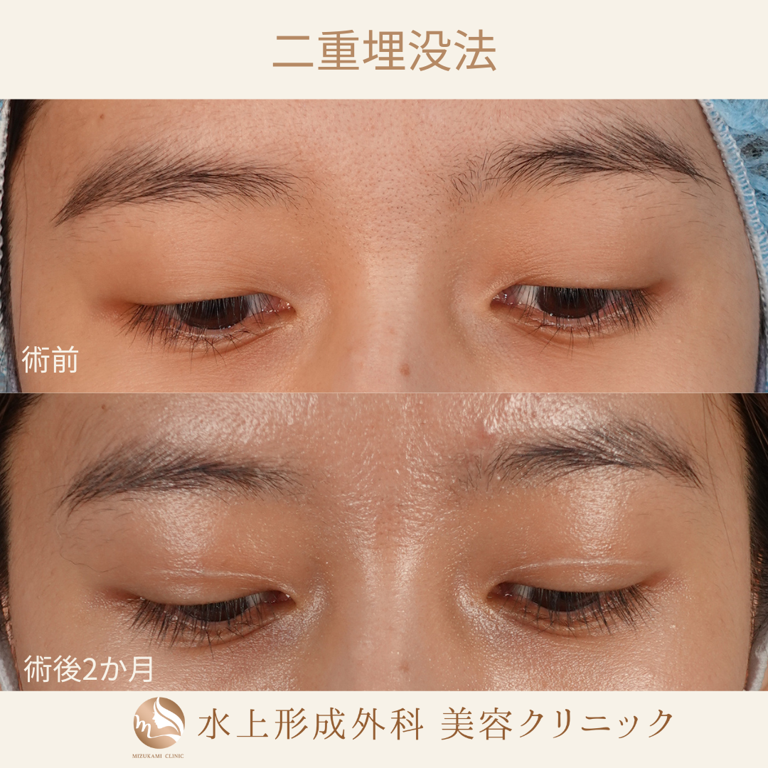 二重埋没法⑧の症例写真3