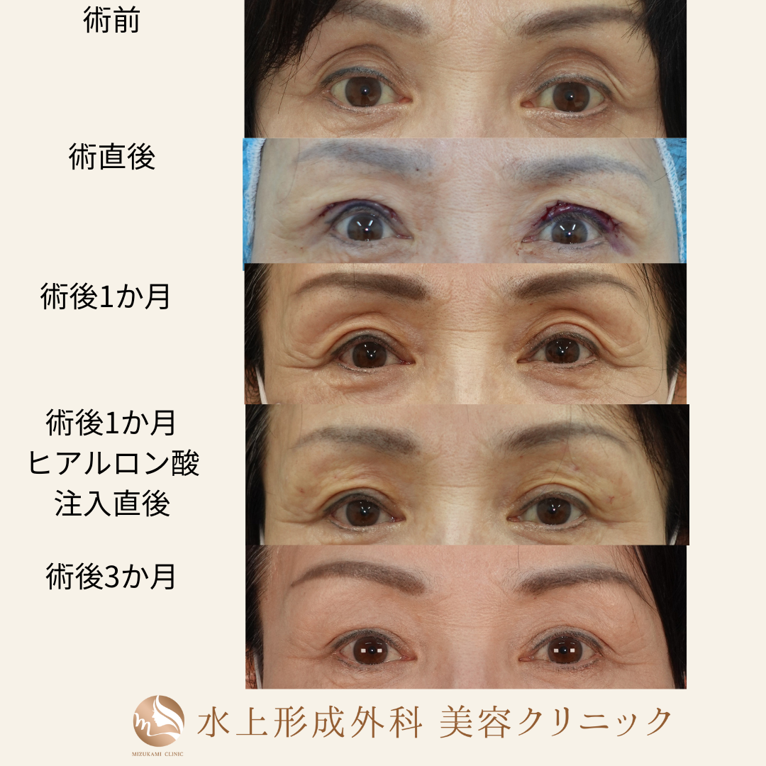 眼瞼下垂症手術の症例写真3