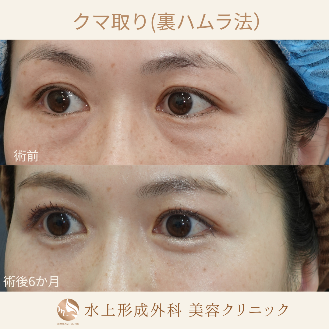 クマ取り（裏ハムラ）の症例写真2