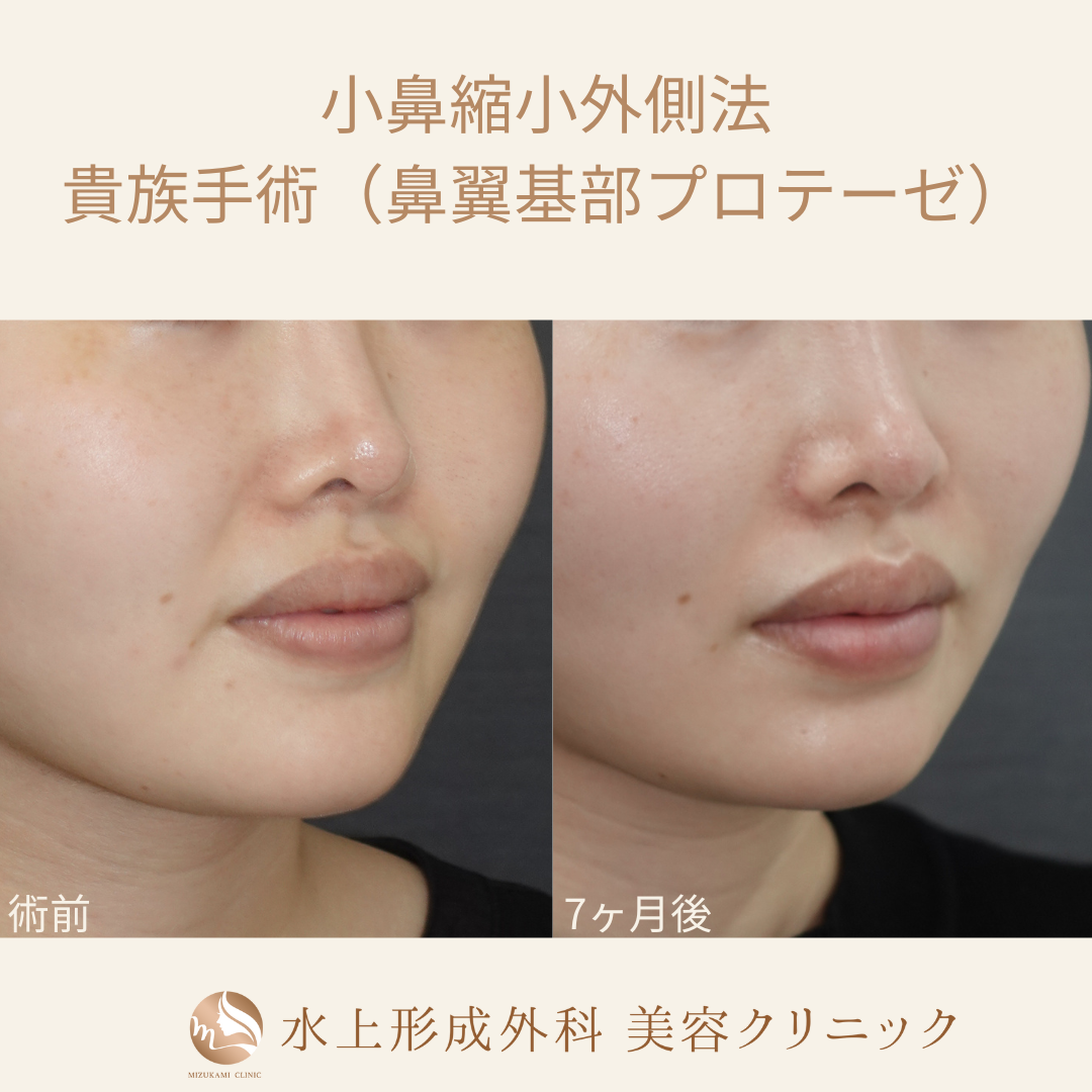 小鼻縮小術（外側法）、貴族手術（鼻翼基部プロテーゼ）
