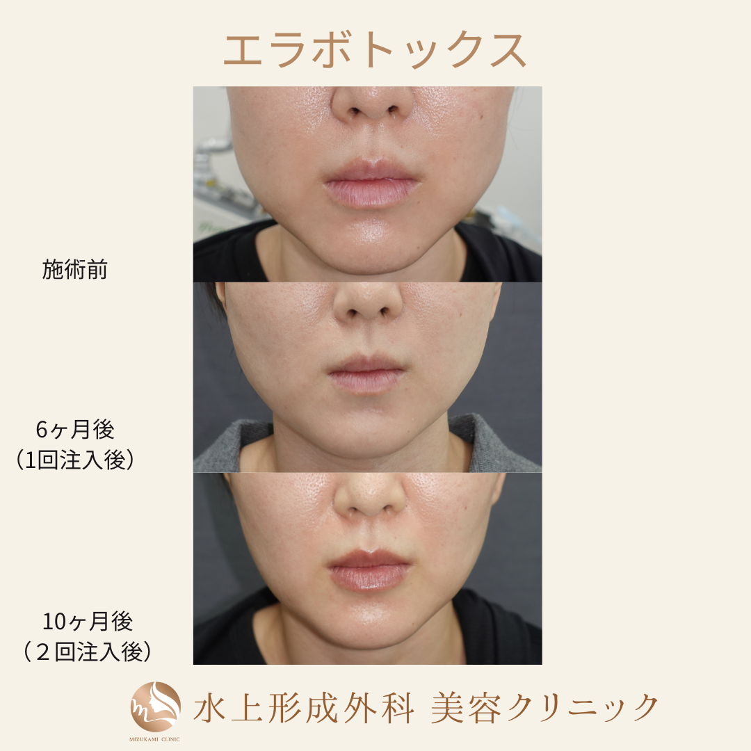 エラボトックスの症例写真2
