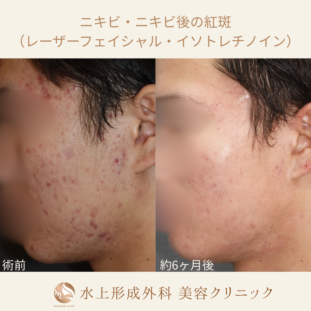 ニキビ・ニキビ痕（レーザーフェイシャル カスタマイズ・イソトレチノイン）の症例写真3