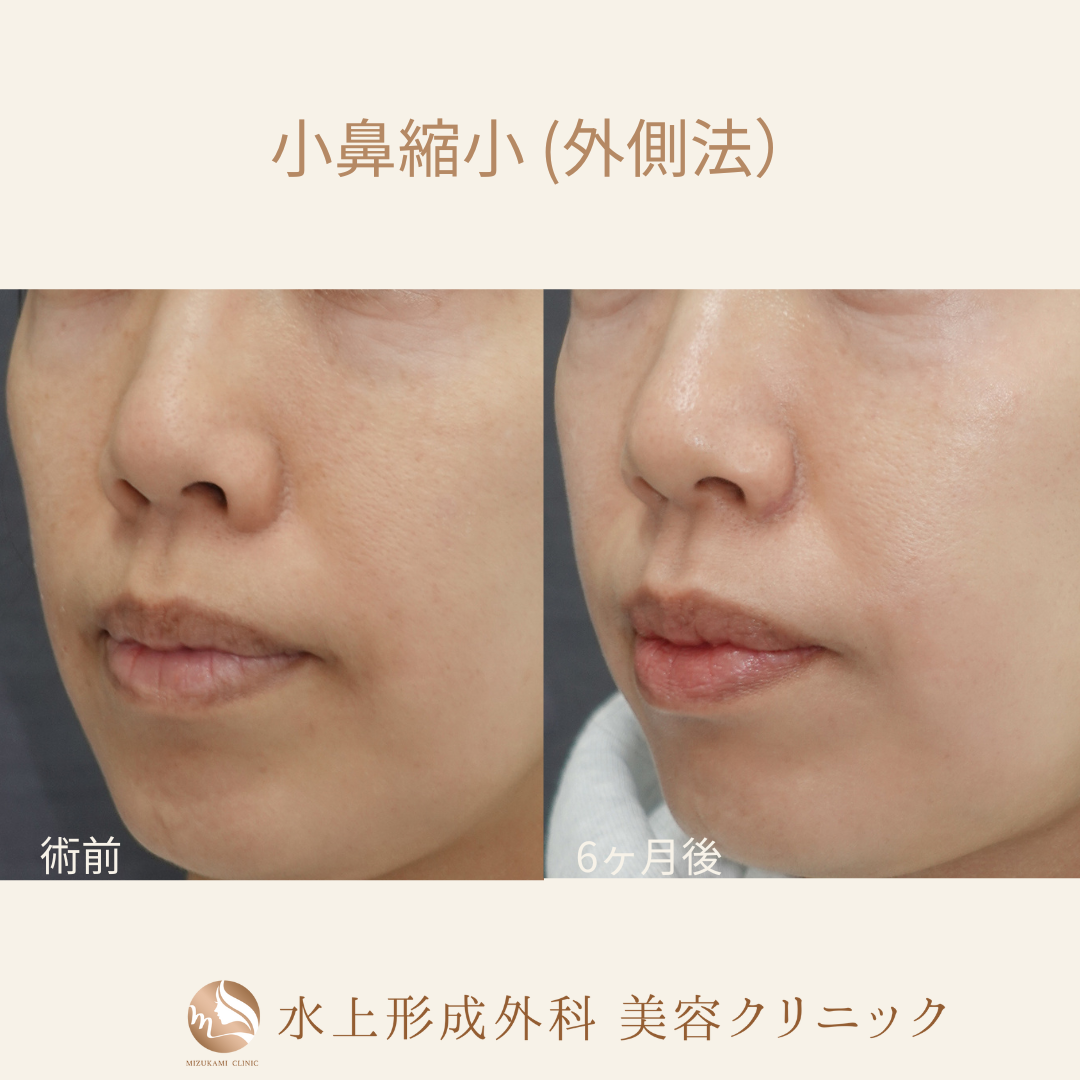 小鼻縮小術（外側法）