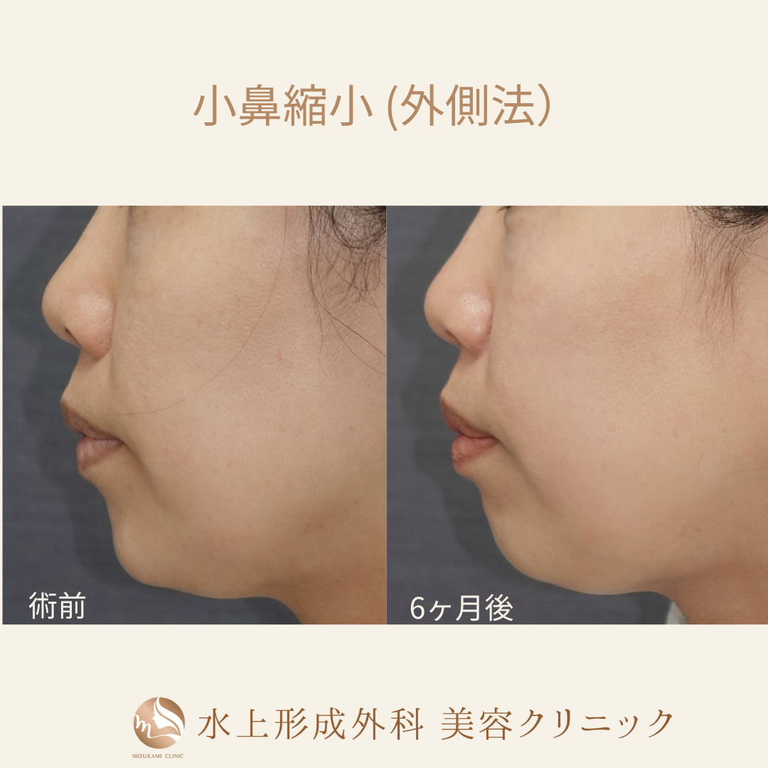 小鼻縮小術（外側法）の症例写真2