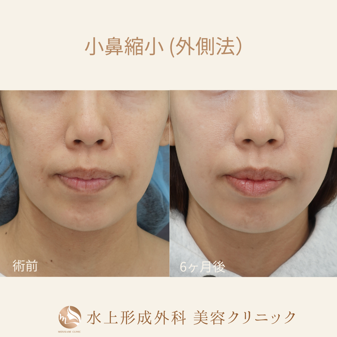 小鼻縮小術（外側法）の症例写真3