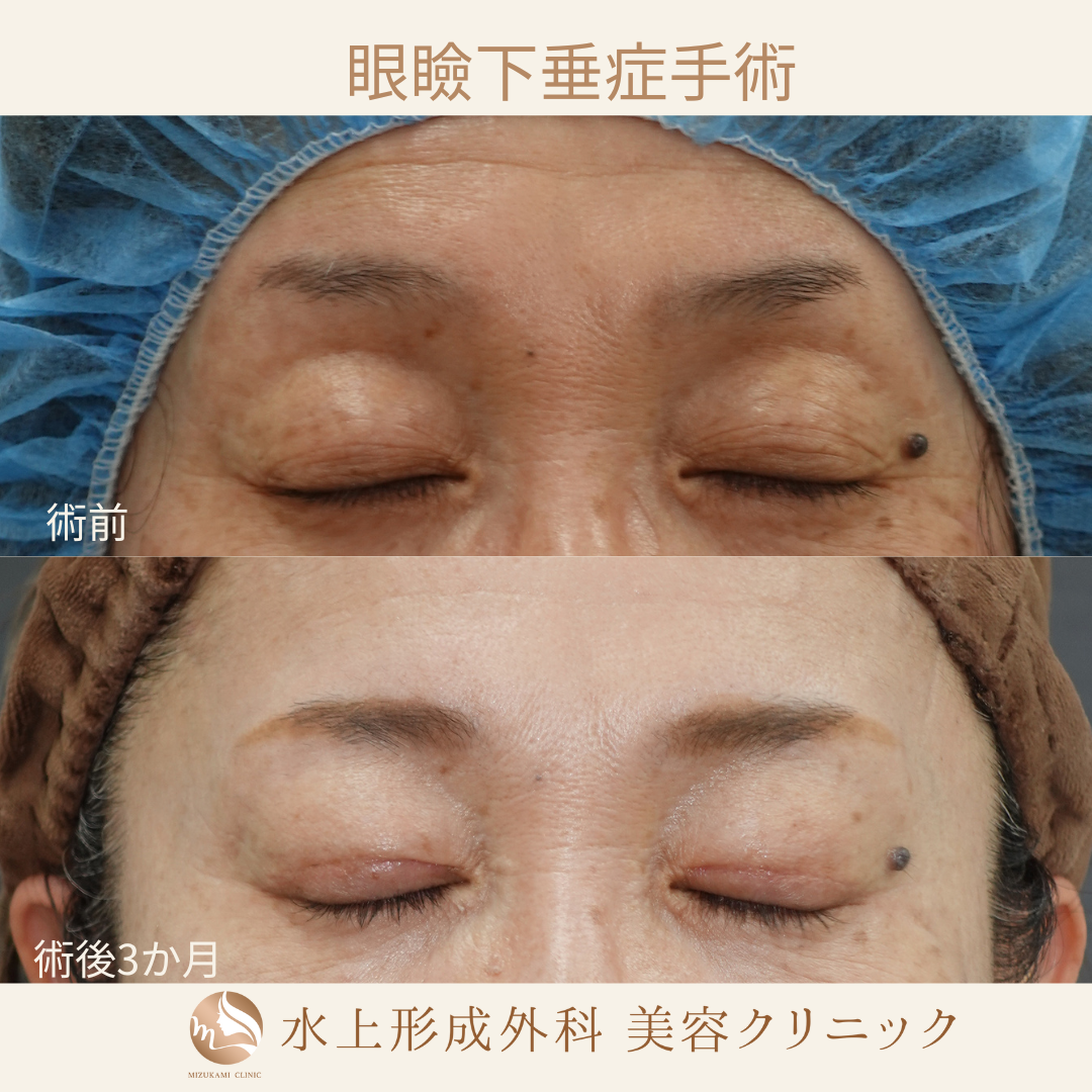 眼瞼下垂症手術の症例写真2