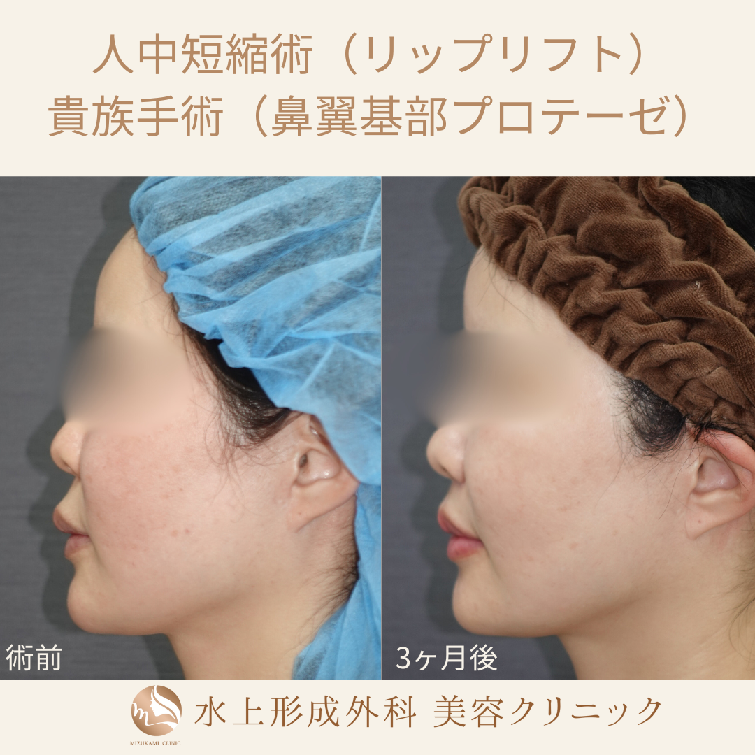 人中短縮術（リップリフト）、貴族手術（鼻翼基部プロテーゼ）の症例写真3