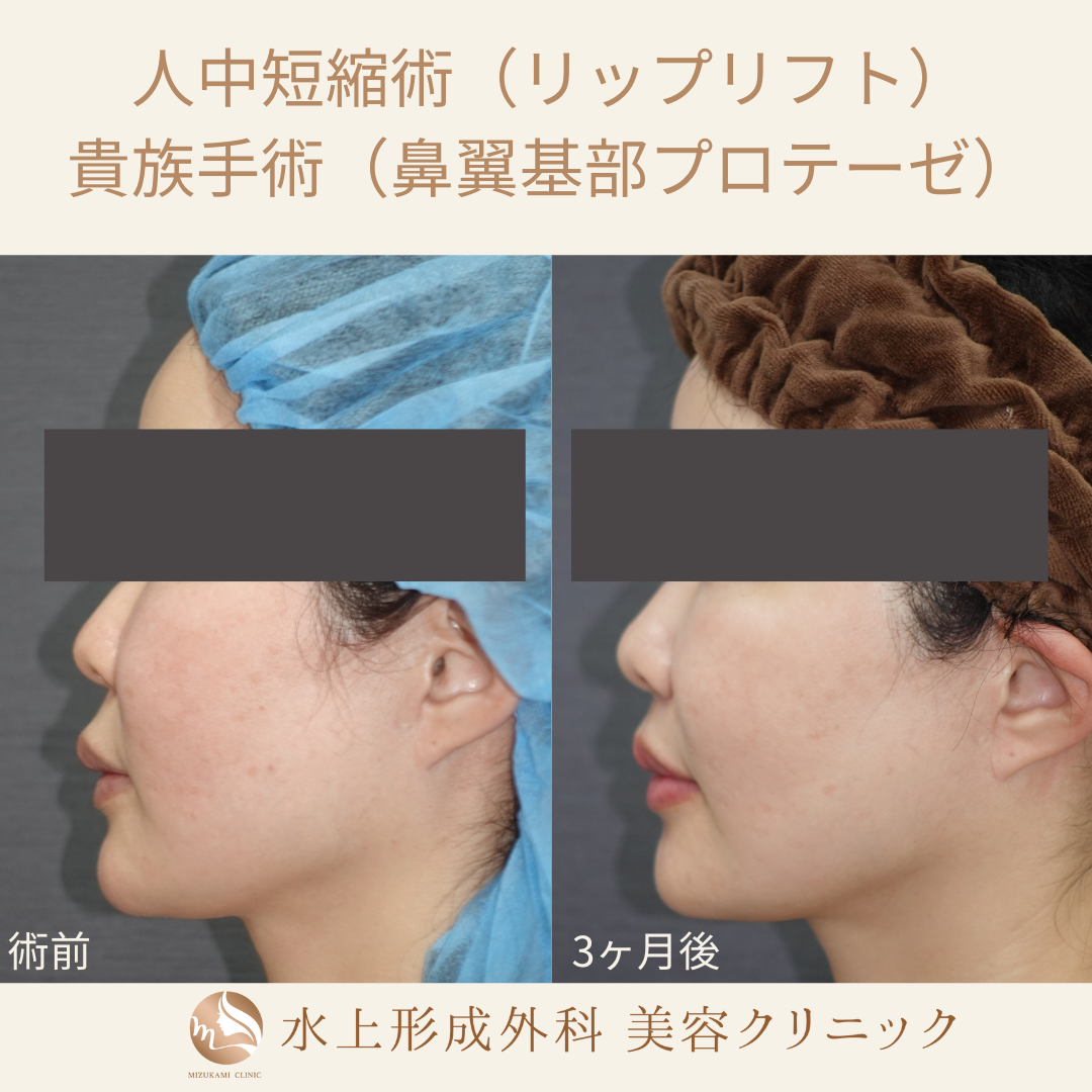 人中短縮術（リップリフト）、貴族手術（鼻翼基部プロテーゼ）の症例写真3