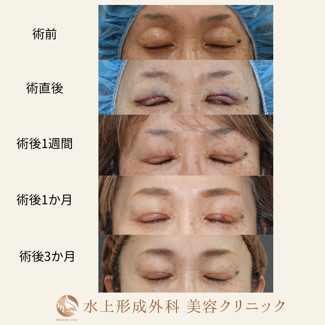 眼瞼下垂症手術の症例写真4
