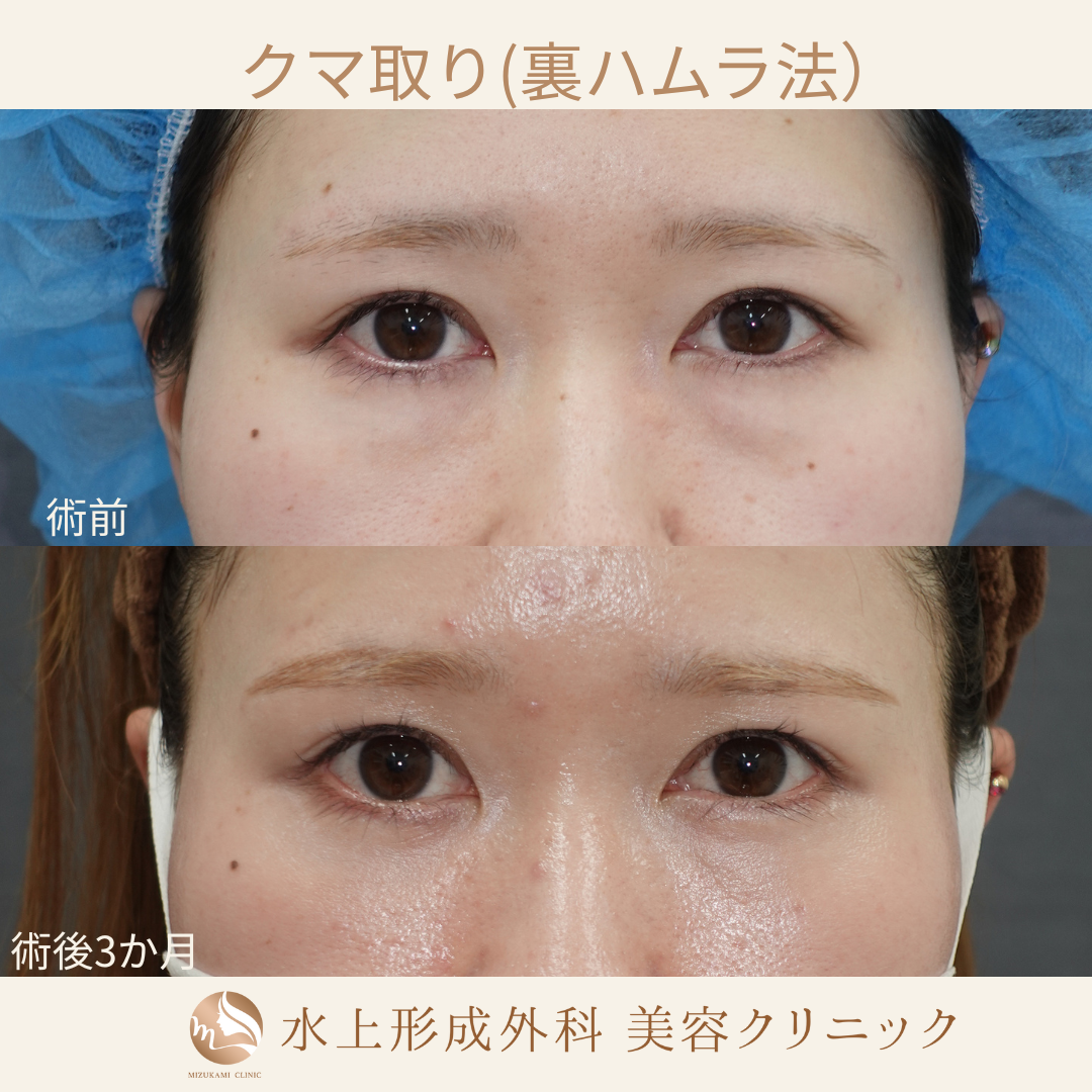クマ取り（裏ハムラ）の症例写真2