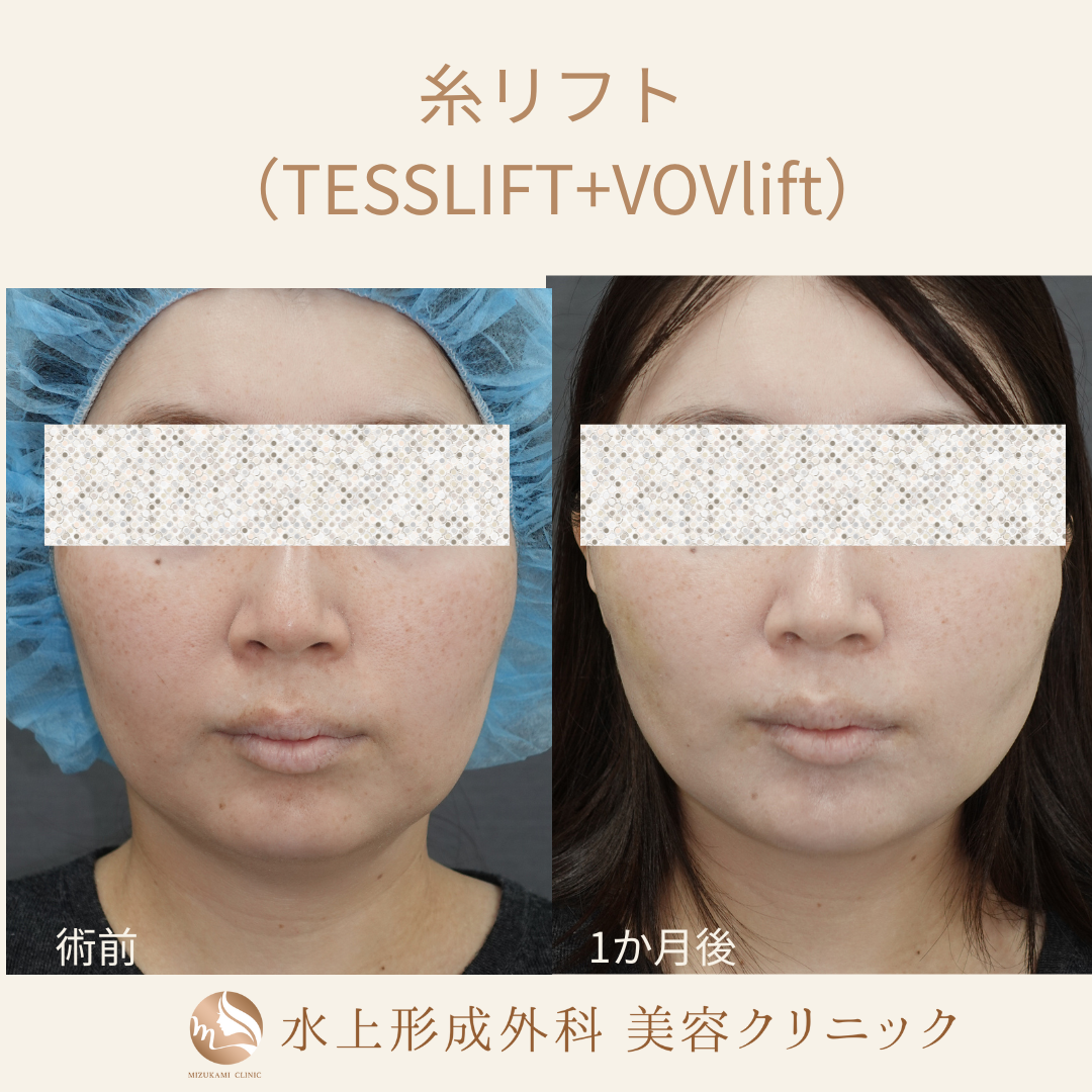 糸リフトの症例写真2
