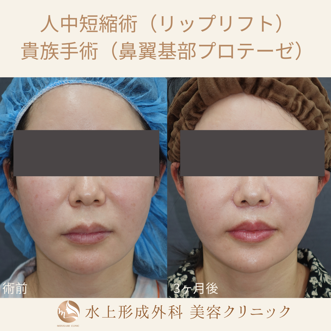 人中短縮術（リップリフト）、貴族手術（鼻翼基部プロテーゼ）の症例写真2