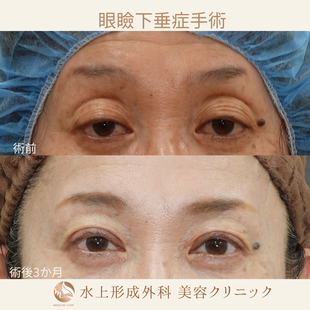 眼瞼下垂症手術