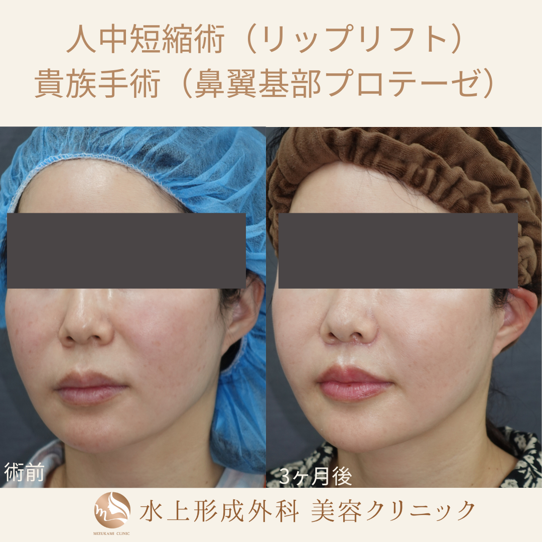 人中短縮術（リップリフト）、貴族手術（鼻翼基部プロテーゼ）